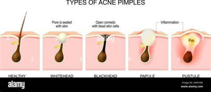 Why do I get a pimple in the same spot?