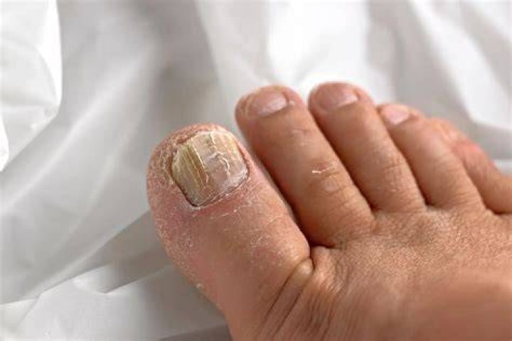 Why do I have so much toe jam?