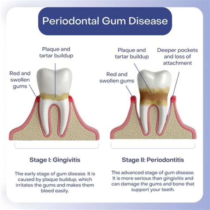 Why periodontitis is painless?