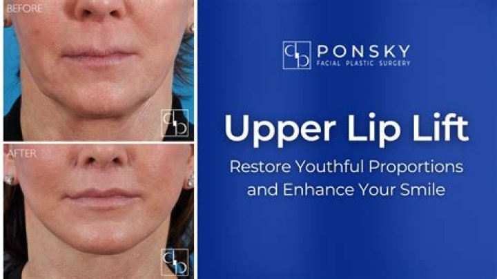 Will a lip lift change my smile?