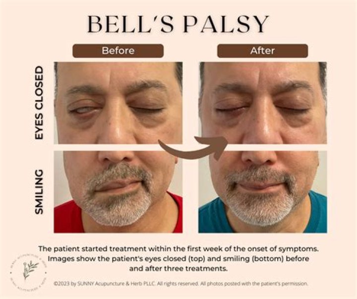 Will my eye go back to normal after Bell's palsy?