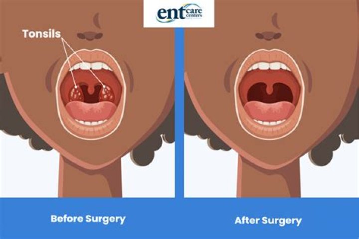 Will removing my tonsils stop snoring?